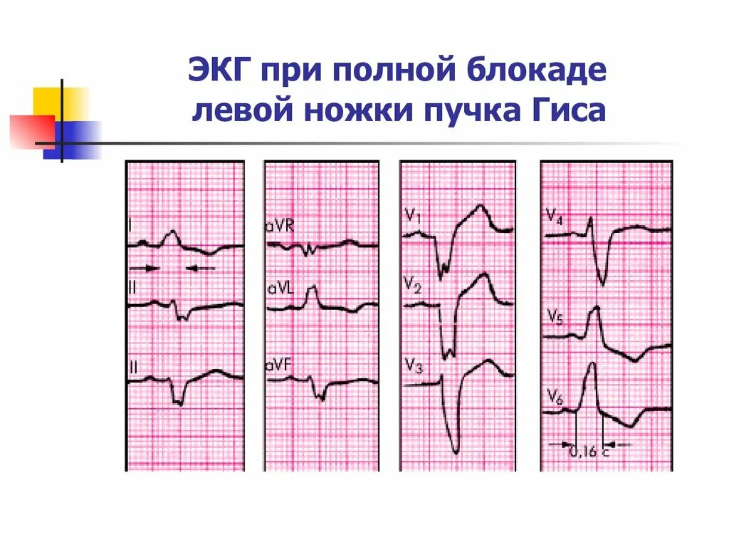 Блокада левой ножки п гиса. Неполная блокада ЛНПГ на ЭКГ. Неполная блокада левой ножки пучка Гиса. Блокада левой ножки пучка Гиса на ЭКГ. Блокада ПНПГ на ЭКГ.