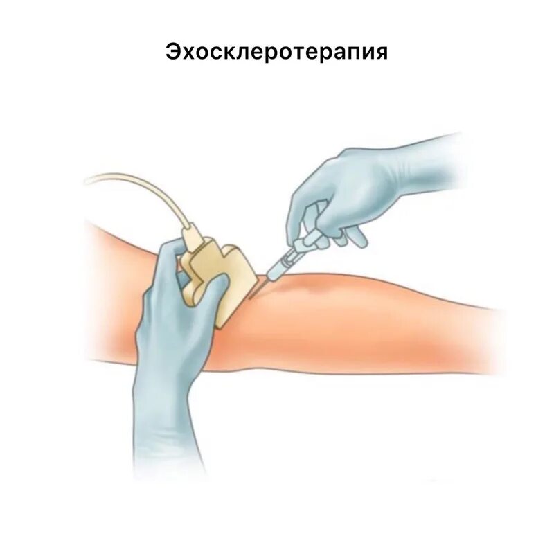 Введение инсулина подкожно шприц ручкой. Склеротерапия варикозной болезни. Эхосклеротерапия вен нижних конечностей. Способ введения склерозанта для остановки. Способ введения склерозанта для остановки.