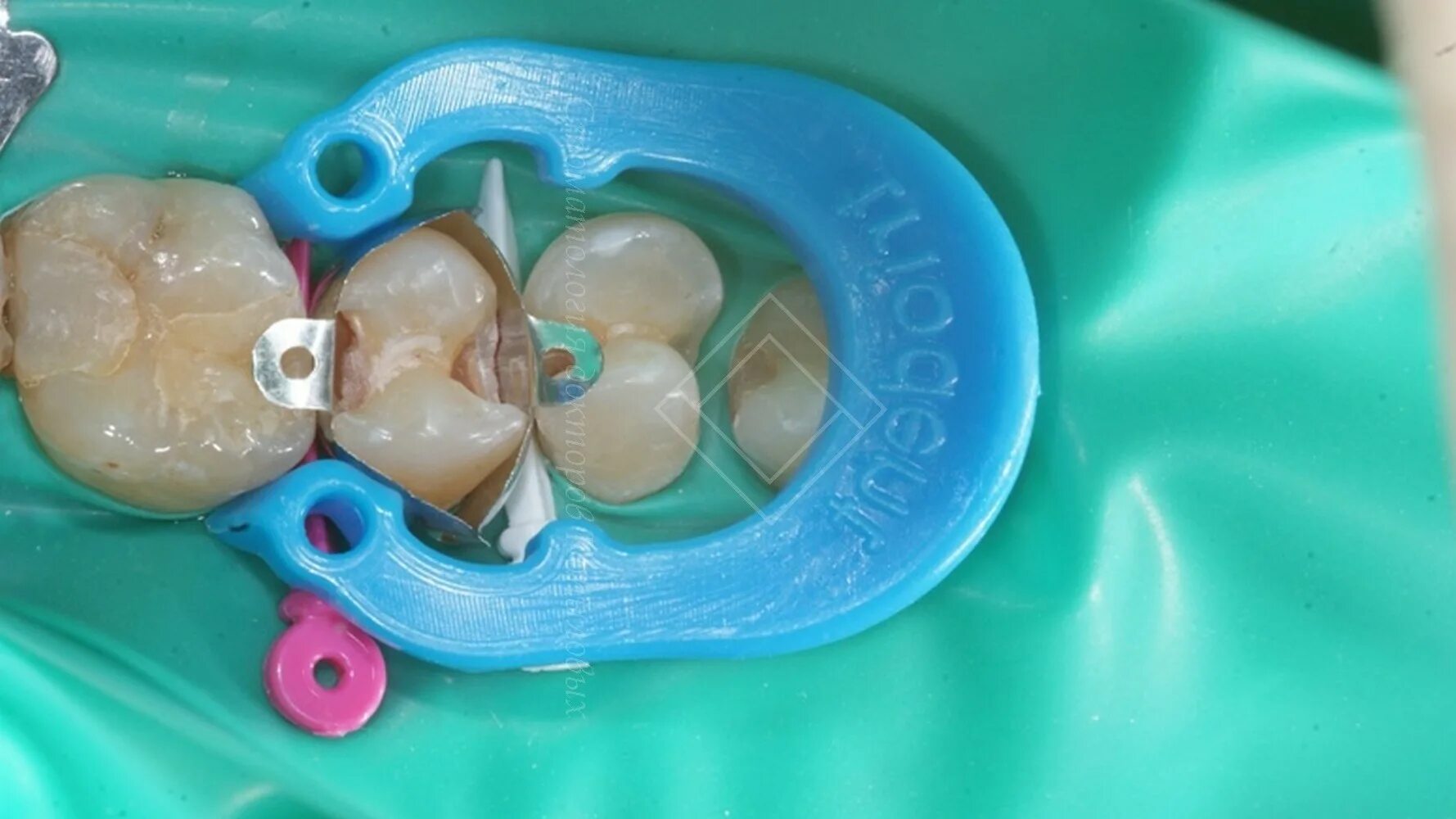 Цветные пломбы детские. Светоотвердевающая пломба. Детские пломбы для детей. Кариес молочных зубов у детей. Пломбирование зубов у детей.