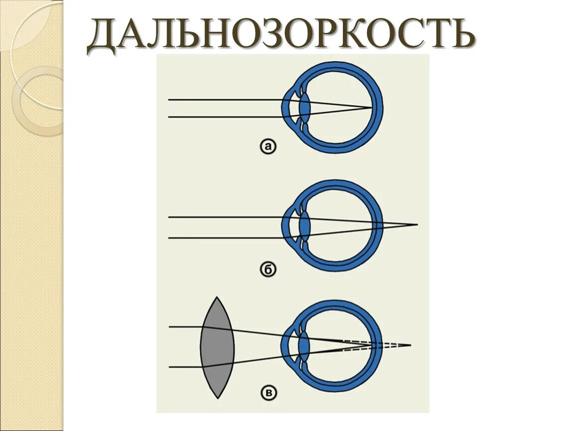 Линзы схема для близорукости и дальнозоркости. Близорукость и дальнозоркость схема физика. Глаз близорукость и дальнозоркость физика. Дальнозоркость оптика. Линзы для зрения дальнозоркость