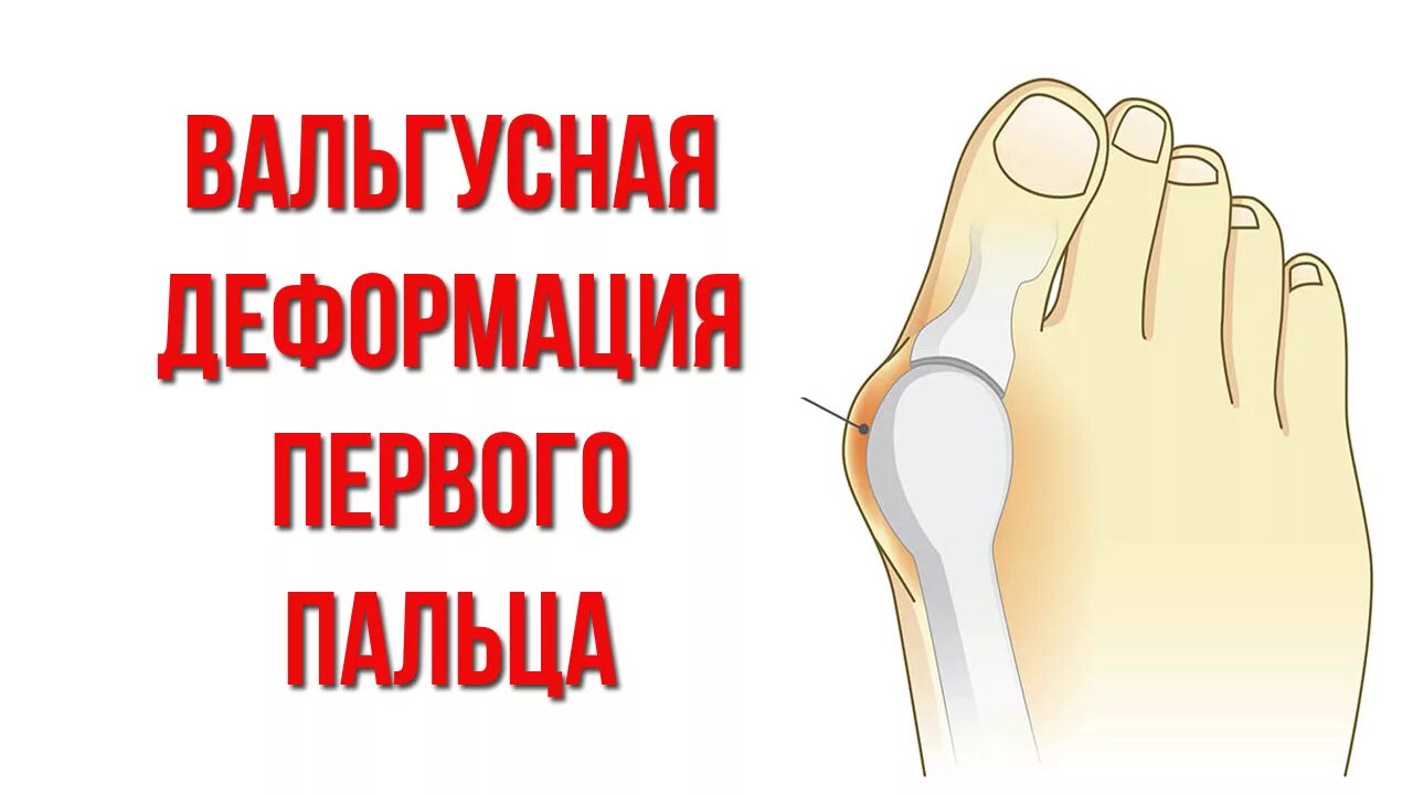 Как лечить вальгусную деформацию большого пальца. Вальгус деформация большого пальца стопы. вальгусная деформация первого пальца стопы. вальгусное искривление пальца стопы. вальгусная деформация 1 пальца стопы.