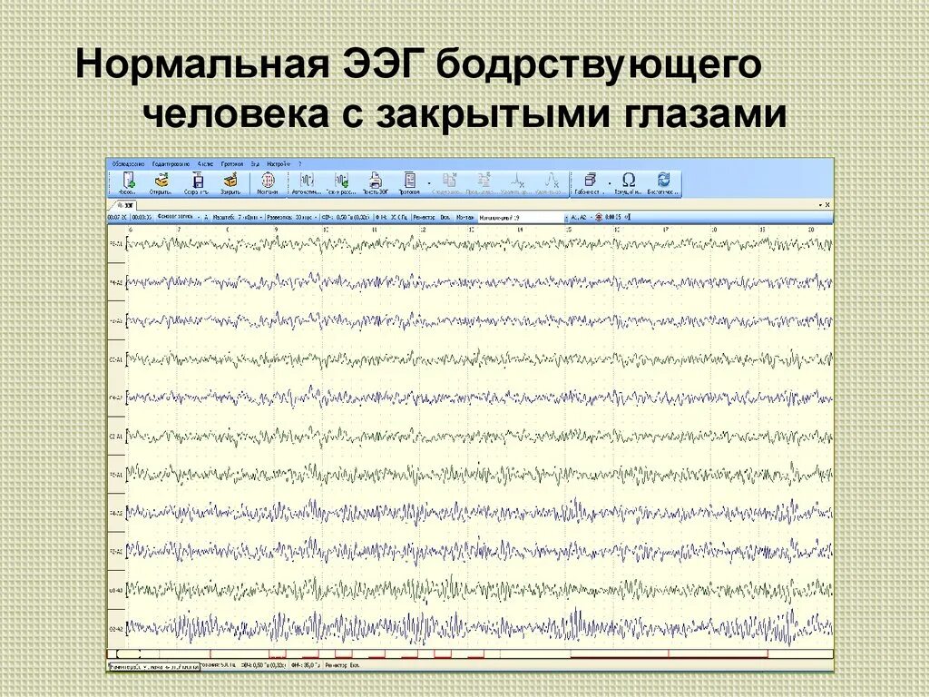 Нормальная диаграмма ЭЭГ. Энцефалограмма головы нормальные показатели. Расшифровка показателей электроэнцефалограммы ЭЭГ головного мозга. ЭЭГ здорового мозга.