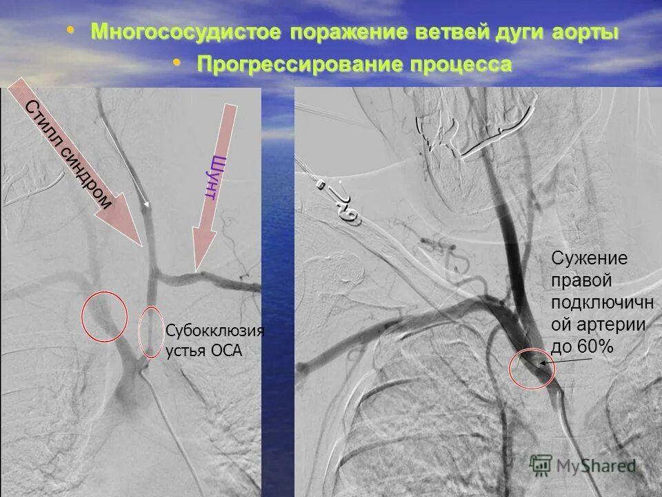 стенозы пна до 60