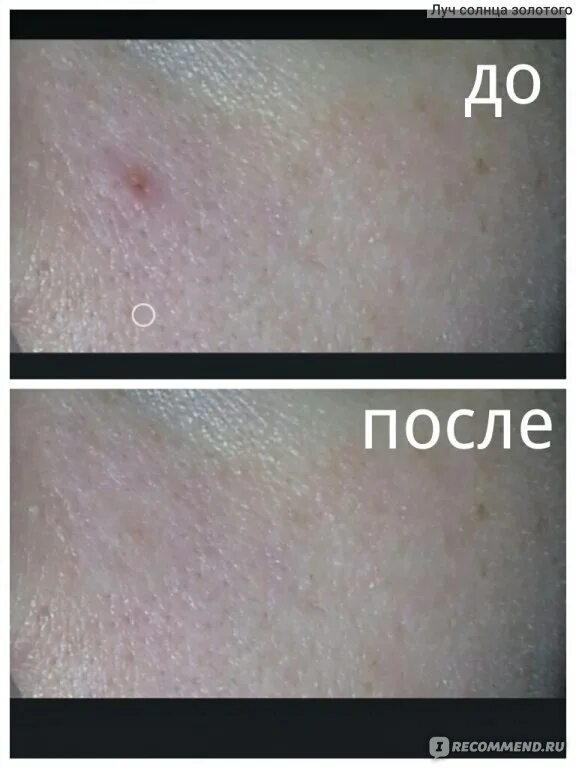 Что сделать чтобы прыщ быстрее прошел. Наклейки убирающие прыщи. закапсулированный прыщики. прыщи на спине удалить лазером.