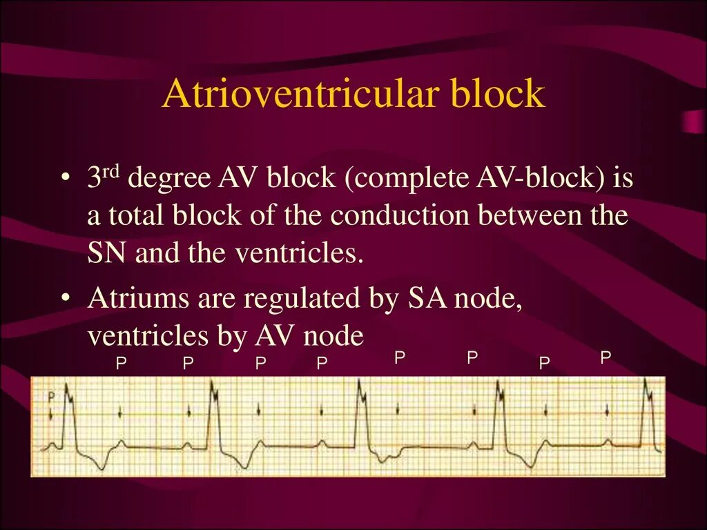 3rd degree av Block ECG. Av Block 3rd degree. ECG av Block 3. Atrioventricular Block.