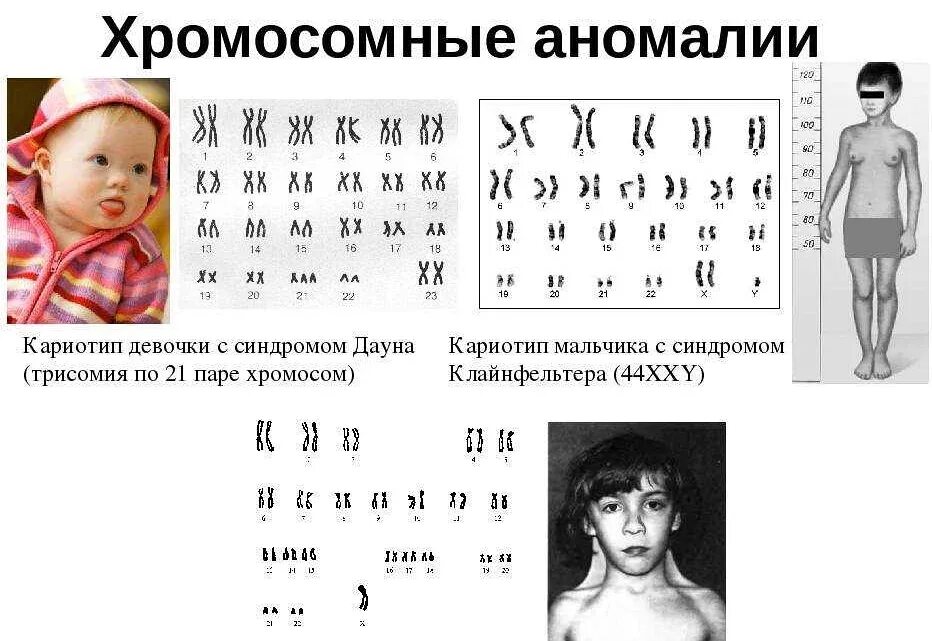 Анализ хромосомного набора. Синдром дауна трисомия кариотип. синдром дауна (трисомия по 21 паре хромосом). формула кариотипа при синдроме шерешевского-тернера. синдром шерешевского тёрнера анализ крови.