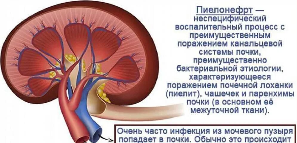 Сильные боли в мочевом