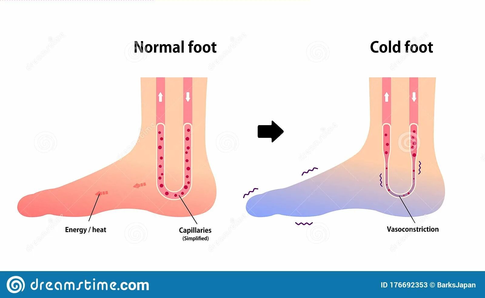 Иннервация кожи нижней конечности. Диабетическая полинейропатия, диабетическая стопа. Дерматомы нижних конечностей. Туннельный синдром большеберцового нерва. Дистальная полинейропатия нижних конечностей.