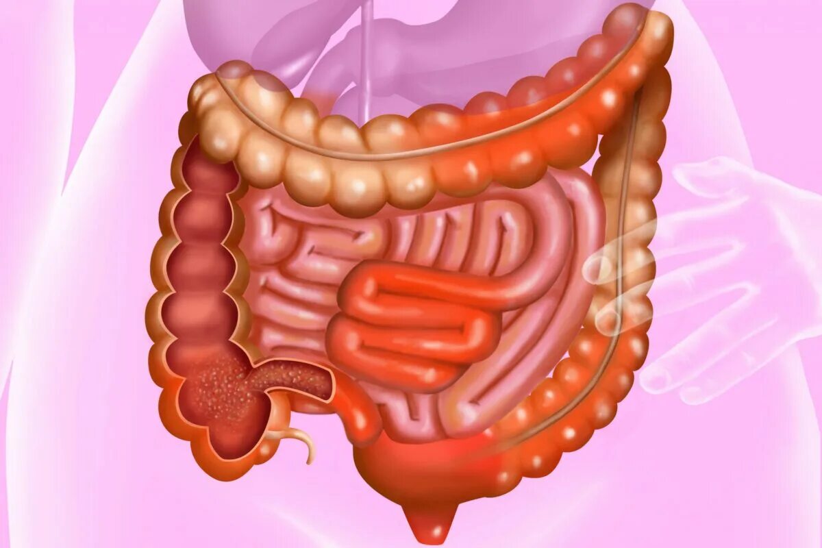 Толстая кишка запор. Кишечник с левой стороны. Раздутая толстая кишка. Воспаления кишечника и запор.