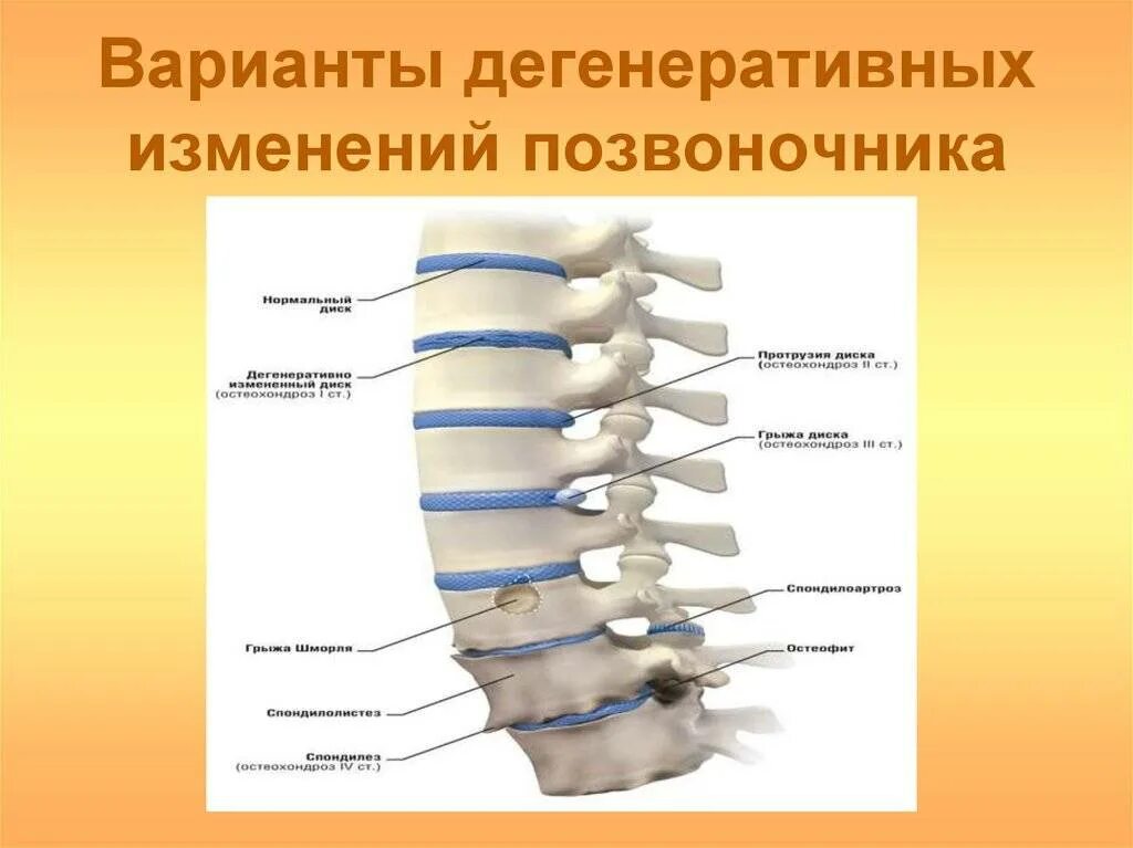 Мр картина дистрофических изменений поясничного отдела позвоночника. Дегенеративно-дистрофические изменения позвоночника что это. Дегенеративные изменения позвонков. Дегенеративные изменения грудного отдела позвоночника что это такое. Дегенеративные изменения в позвонках.