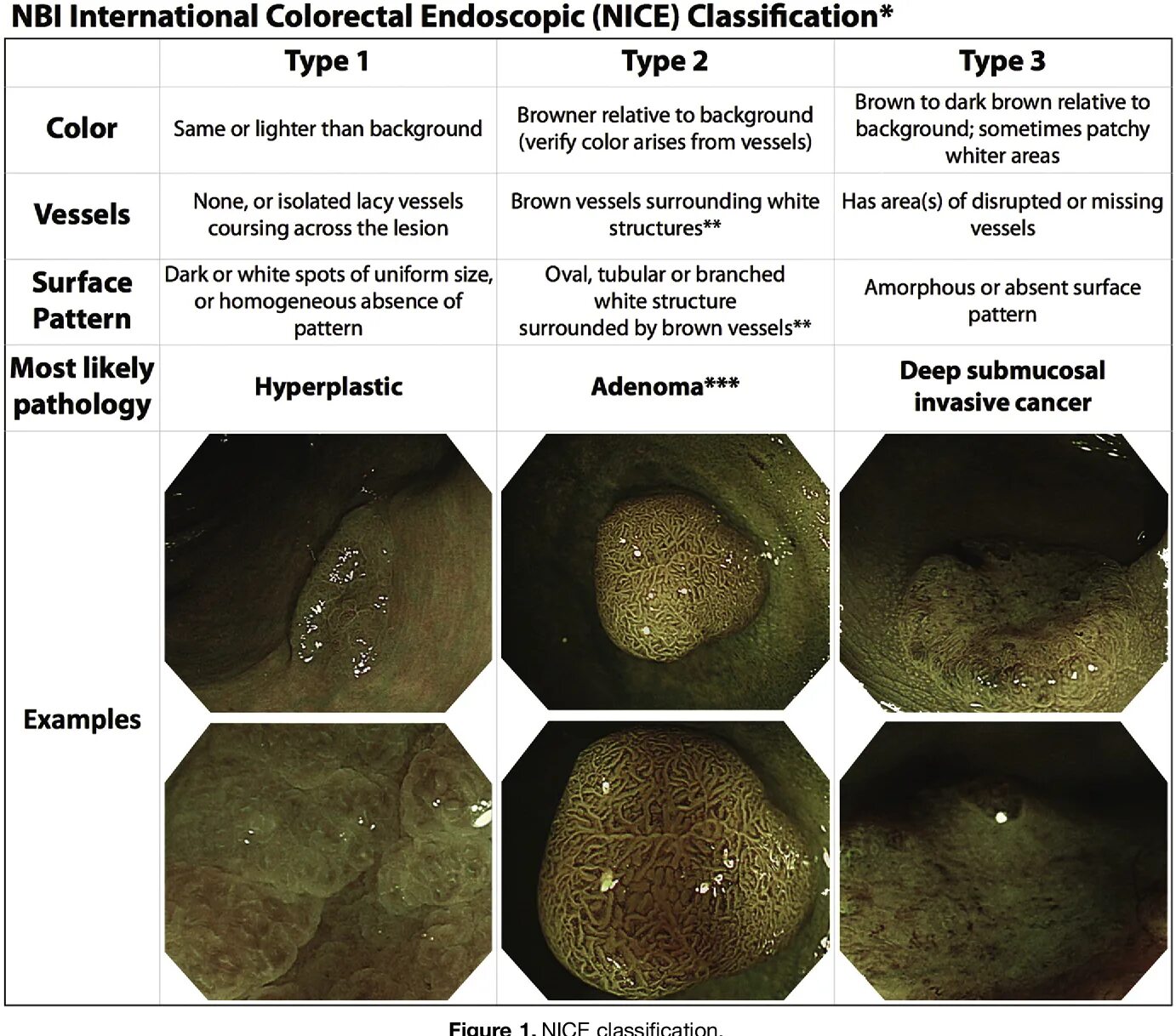 Классификация полипов 0-1s. Nice классификация полипов толстой кишки. Классификация полипов желудка эндоскопическая. Классификация полипов эндоскопия. Классификации эндоскопия