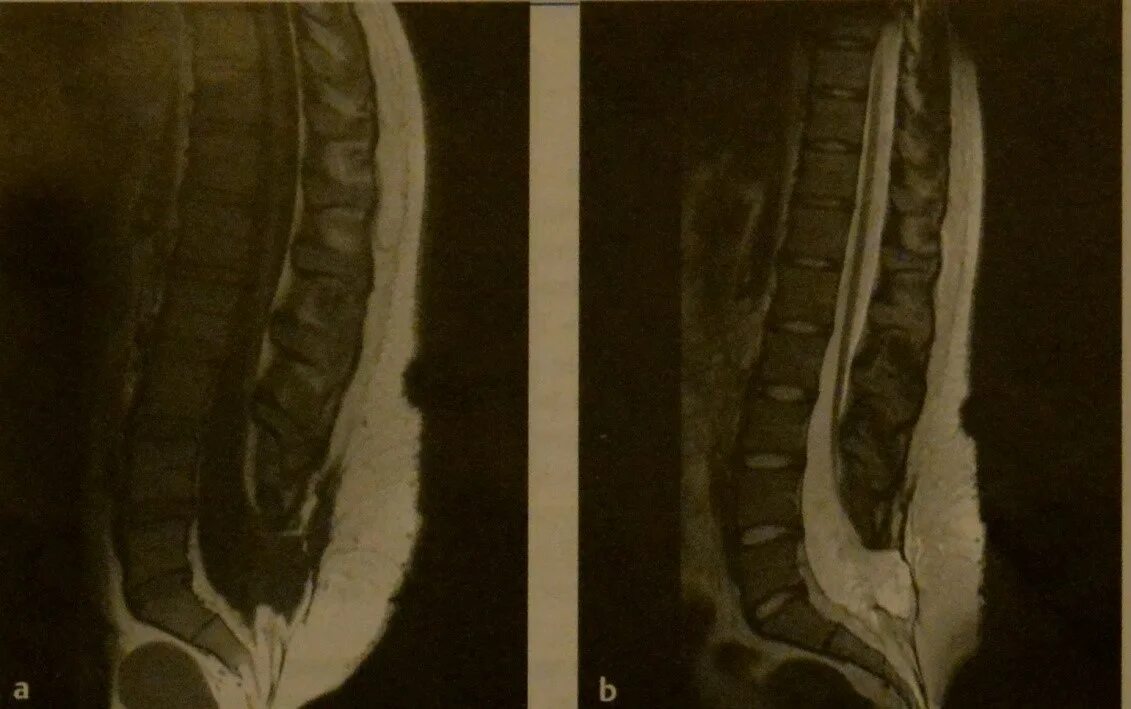 Липома терминальной нити синдром фиксированного спинного мозга. Липома спинного мозга мрт. Липома терминальной ни мрт.