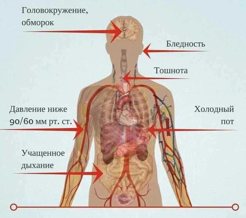 Что есть при пониженном давлении и головокружениях. Низкое давление симптомы. приступ аритмии. низкое давление и тошнота. рвота при низком давлении.