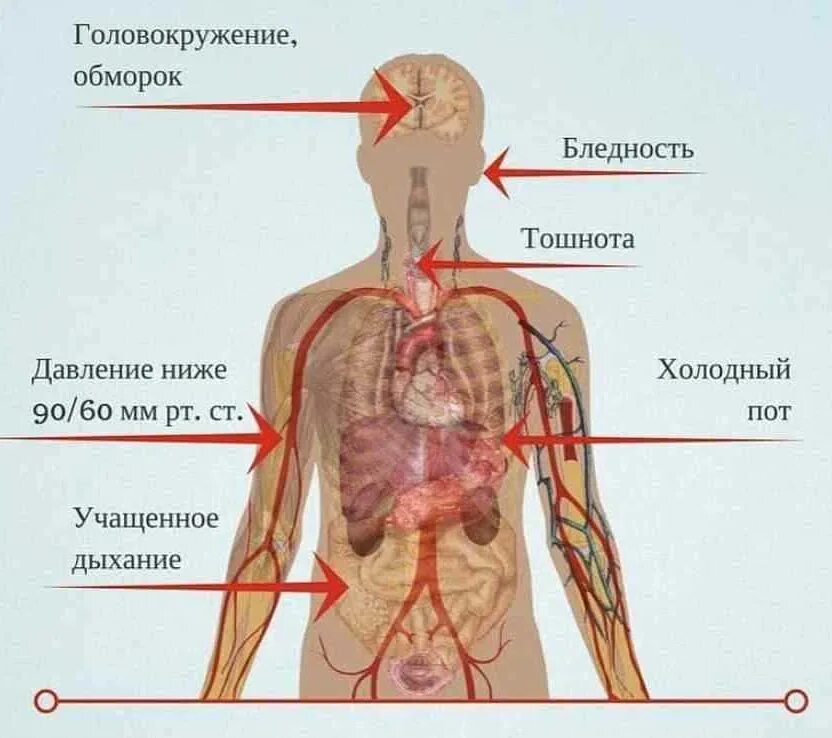 У больного давление. Низкое давление симптомы. Приступ аритмии. Низкое давление и тошнота. Рвота при низком давлении.