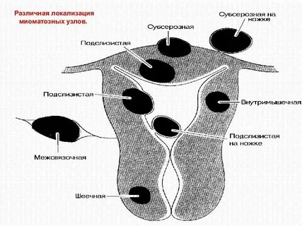 Узел в матке отзывы