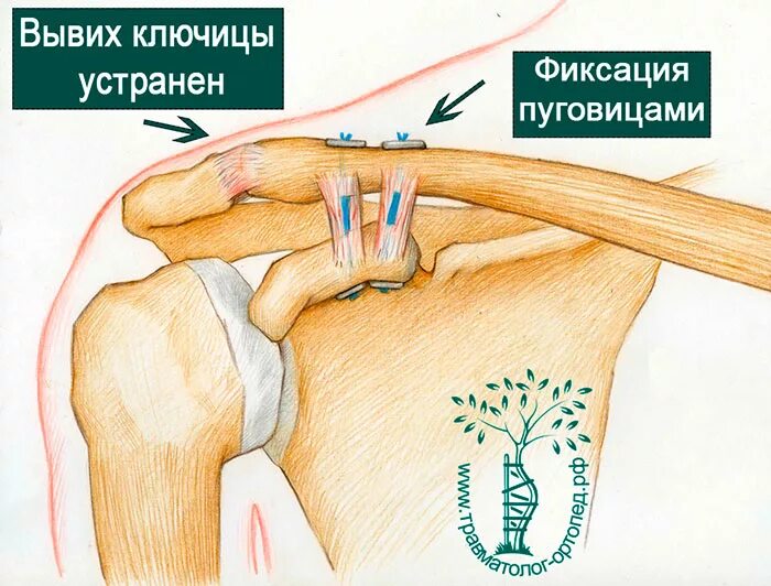 Разрыв связок плечевого сустава акс. Разрыв акс плечевого сустава степени. Вывих грудино ключичного сустава рентген. Акромиально-ключичный сустав разрыв.