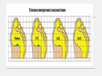 Плоскостопие степени рентген таблица