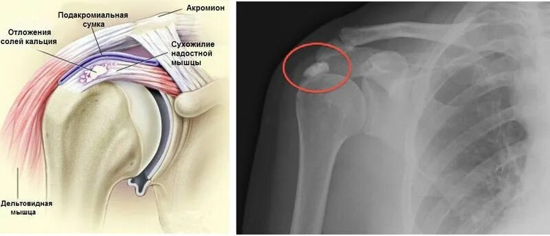 Операция разрыва сухожилия надостной мышцы. Тендинопатия сухожилия надостной мышцы плечевого. Кальцификация сухожилия надостной мышцы. Кальцинирующий тендинит плечевого. Кальцифицирующий тендинит рентген.