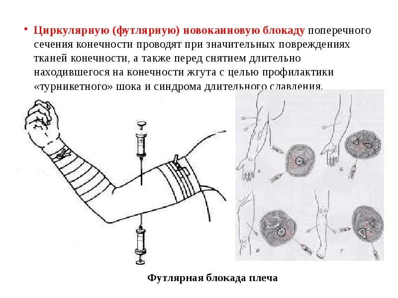 Техника футлярной новокаиновой блокады. Футлярная новокаиновая блокада по вишневскому. Футлярная новокаиновая блокада. Новокаиновая блокада поперечного сечения. Проводниковая новокаиновая блокада техника.