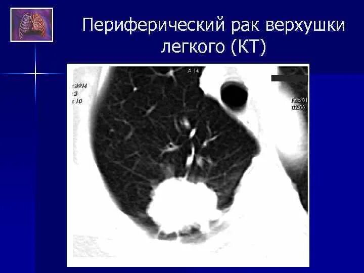 Периферический рак что это. Периферическое образование легкого на кт. Периферическое образование в легком на кт. Периферическое образование легкого. Периферическая опухоль верхней доли правого легкого.