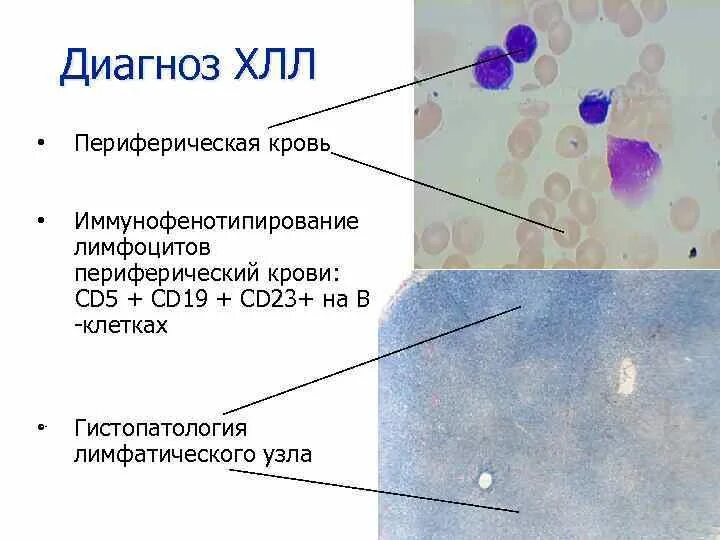 Острый лимфобластный лейкоз иммунофенотипирование. Хронический лимфолейкоз иммунофенотипирование лимфоцитов. Иммунофенотипирование клеток периферической крови. Клетки с фенотипом cd3+cd19-. Хронический лимфолейкоз кровь