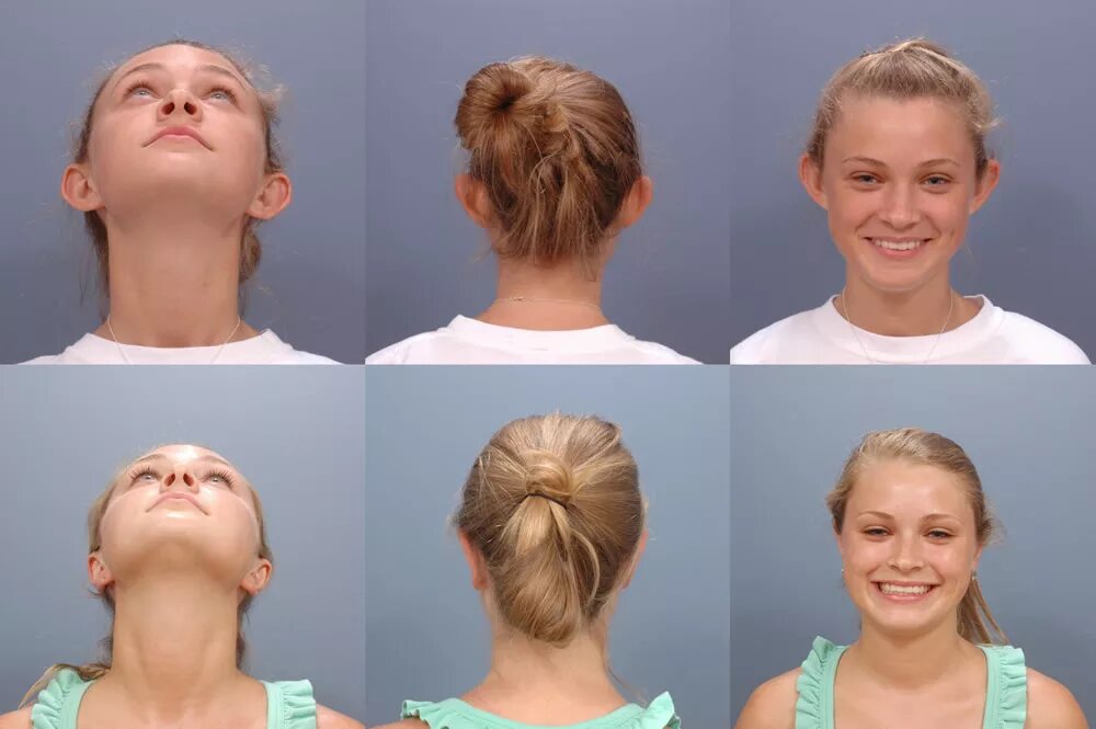 Уменьшение головы. Миноксидил алерана эффект. Ринопластика до и после. Упражнения от второго подбородка. Упражнения от второго подбородк.