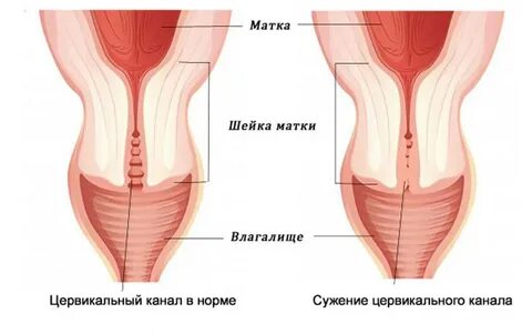 Цервикальный канал шейки матки эпителий