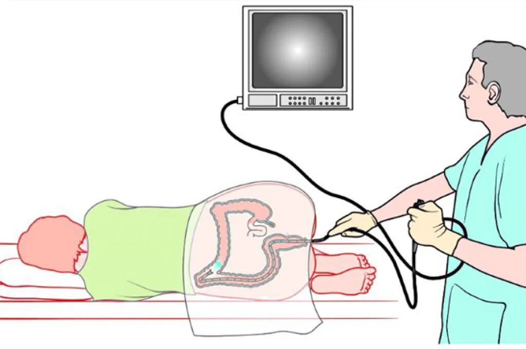 Операции через прямую кишку. Колоноскопия фиброколоноскопия. Эндоскопическое исследование кишечника колоноскопия. Эндоскопическое исследование толстой кишки. Исследование толстой кишки колоноскопия.