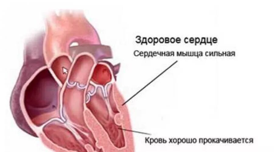 Повышенный сердечный выброс. Сердечная недостаточность фракция выброса. Сердечная недостаточность левого желудочка. Выброс в сердце что такое. Увеличенный сердечный выброс.