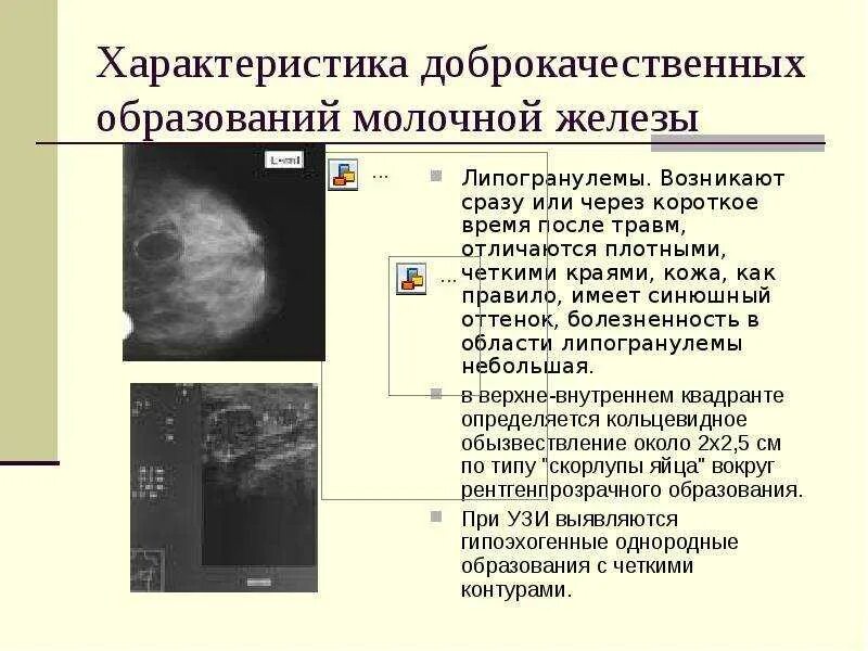 Филлоидная фиброаденома молочной железы УЗИ. УЗИ признаки доброкачественных опухолей молочных желез. Доброкачественная опухоль молочной железы на УЗИ. Опухоль молочной железы на УЗИ. Как определить доброкачественная или злокачественная опухоль