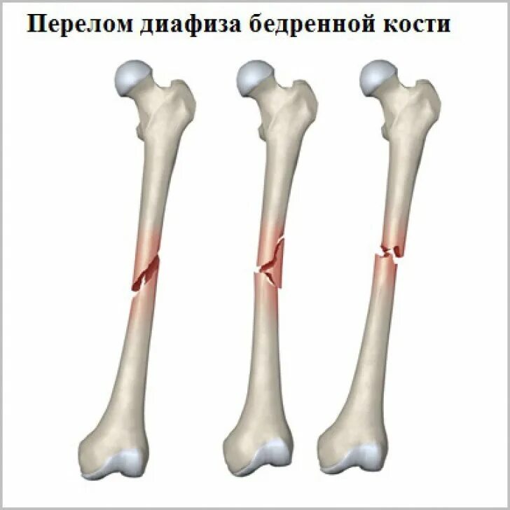 Сколько заживает бедро. Перелом тела диафиза бедренной кости. Перелом бедренной кости в средней трети диафиза. Переломы диафизарной (средней) части бедренной кости. Перелом бедра диафиза бедренной кости.