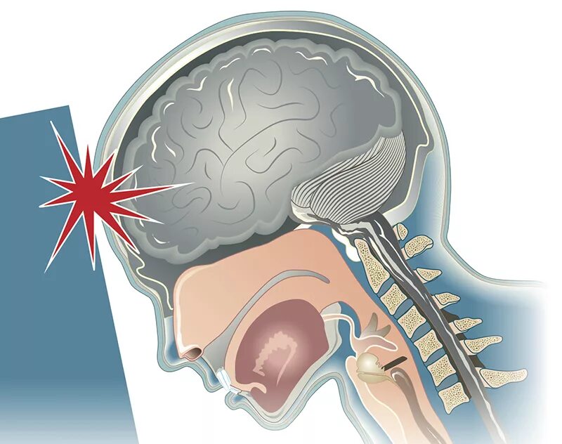 Рвота после сотрясения. Сотрясение головного мозга. Сотрясение головного МОЗ. Микросотрясения мозга.