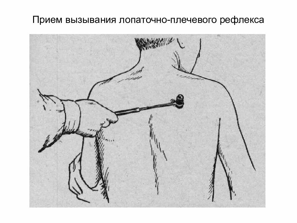 Рефлекс плеча. Лопаточный рефлекс Бехтерева. Лопаточно плечевой Бехтерева. Лопаточно плечевой рефлекс. Исследование лопаточно-плечевого рефлекса.