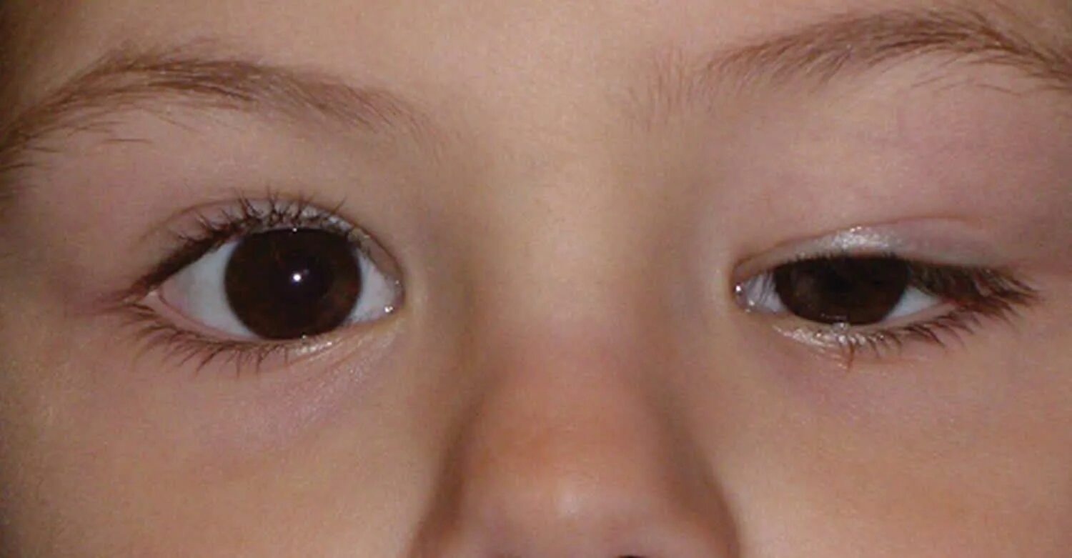 Детская глазная болезнь. Врожденный блефароптоз. Птоз век офтальмология.