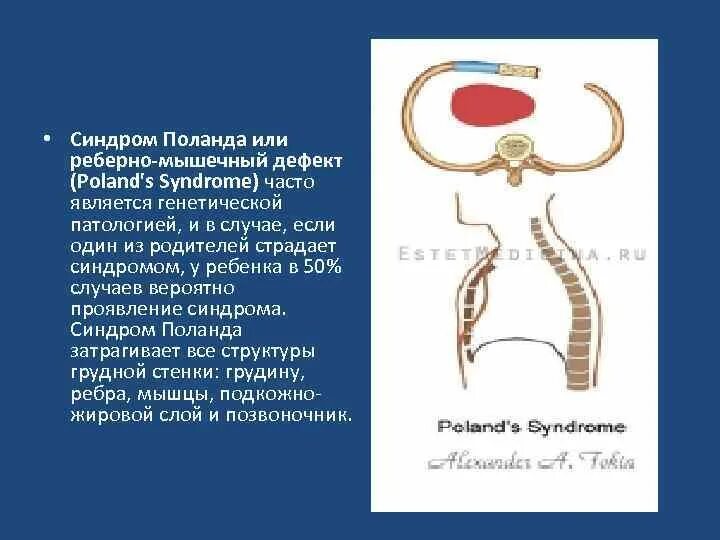 Мышечный дефект. Синдром поланда или реберно-мышечный дефект. синдром поланда клинические рекомендации. синдром поланда презентация. синдром поланда у младенца.