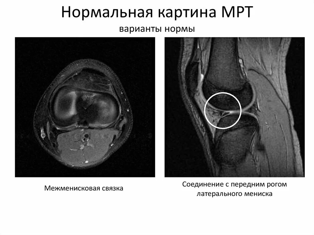 Разрыв мениска мрт. Межменисковые связки мрт. Анатомия менисков коленного сустава мрт. Разрыв передней межменисковой связки мрт. Передний Рог латерального мениска мрт.