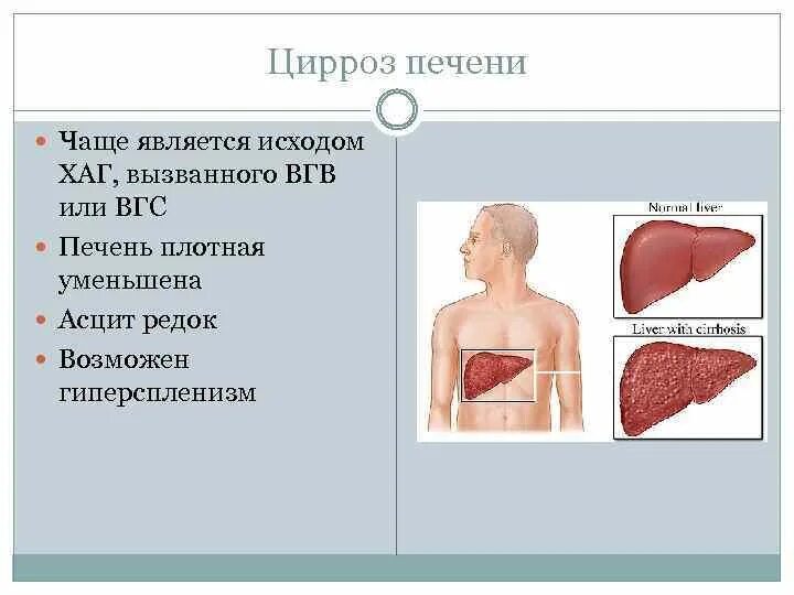 Цирроз печени асцит карта вызова. Цирроз печени карта вызова скорой.