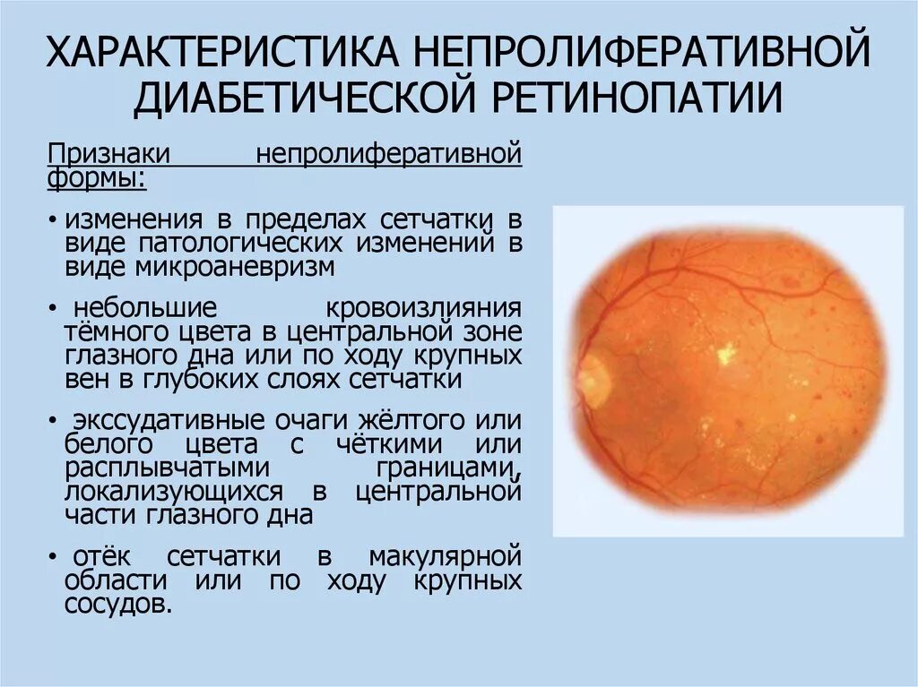 Диабет сетчатка. Диабетическая ретинопатия глазное дно. пролиферативная диабетическая ретинопатия симптомы. пролиферативная фаза ретинопатия. препролиферативная диабетическая ретинопатия глазное дно.