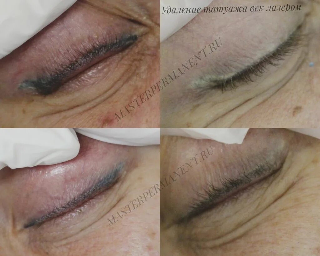 удаление татуажа век отзывы