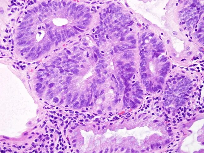 Тубулярная аденома толстой. Тубулярная аденома гистология. Тубуло-ворсинчатая аденома толстой кишки микропрепарат. Тубуло-ворсинчатая аденома толстой.
