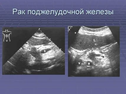 Рак головки поджелудочной железы сколько живут