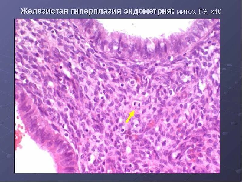 Разрастается эндометрий. Железистая гиперплазия гистология. Эндометриальный полип гистология. Сложная гиперплазия эндометрия гистология. Гиперплазия эндометрия эндометрит.