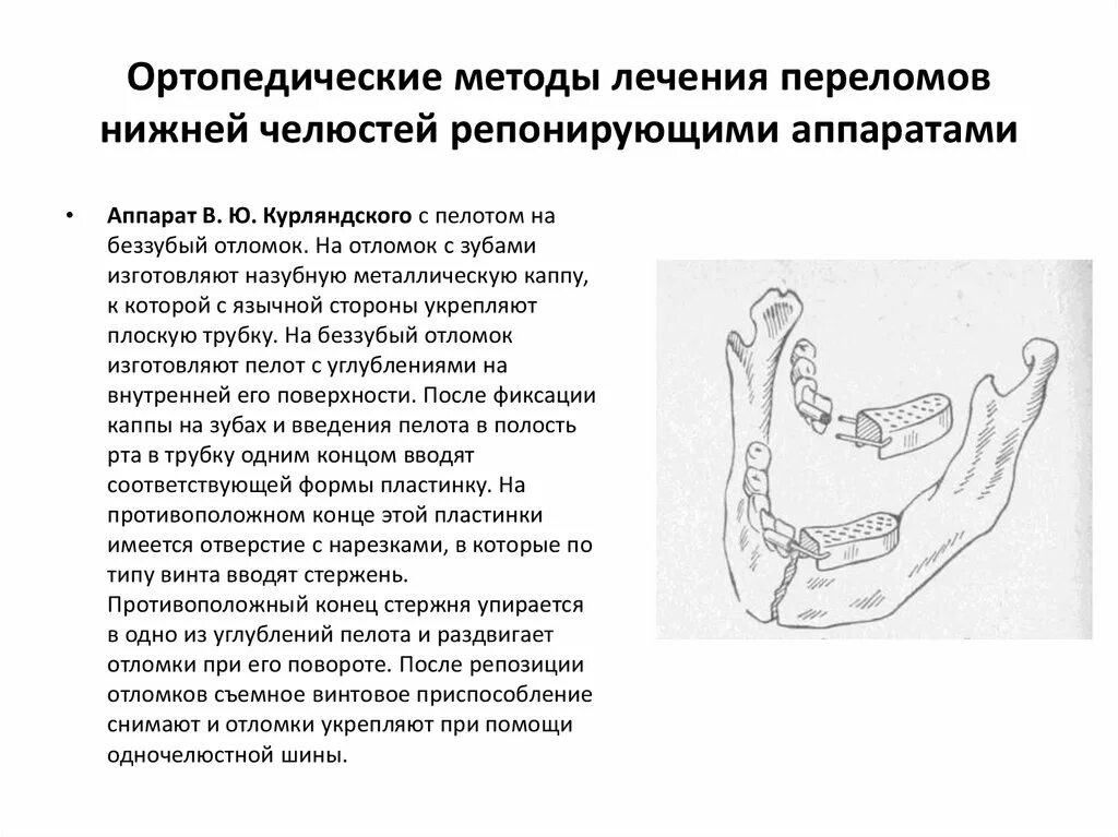 Ортопедические методы лечения переломов нижней челюсти. Ортопедический метод лечения перелома верхней челюсти. Аппарат при переломе мыщелкового отростка нижней челюсти. Хирургические методы лечения переломов нижней челюсти. Ортопедический этап лечения