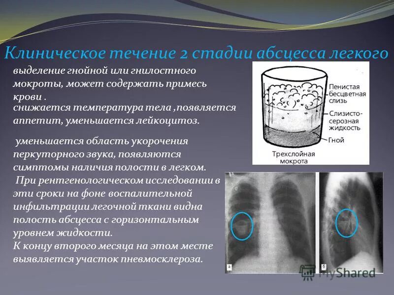 Гнойная мокрота какая