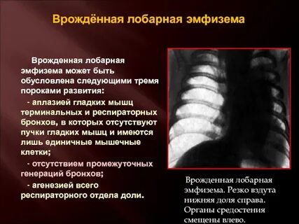 Врожденная долевая эмфизема
