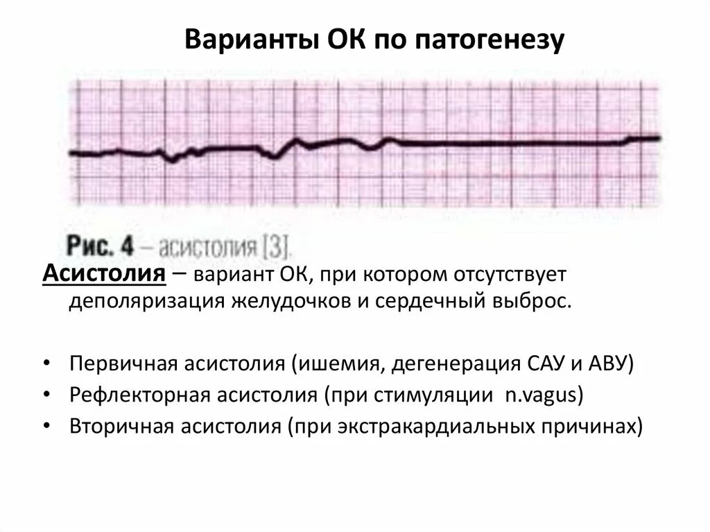 Асистолия что это. Смерть на ЭКГ асистолия. Асистолия желудочков. ЭКГ при асистолии. Асистолия при кардиостимуляторе.