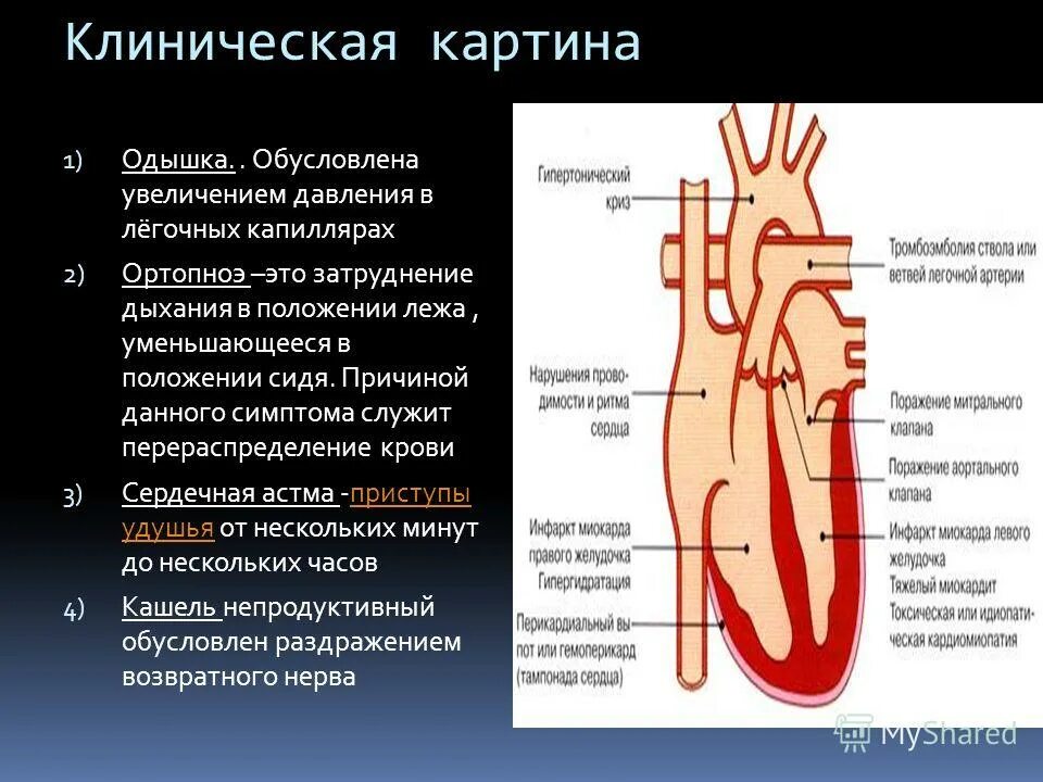 Сердечная недостаточность попала в легочную артерию. Повышение гидростатического давления. Причины повышения диастолического давления. Осмотическое давление крови формула. Физиология микроциркуляции.