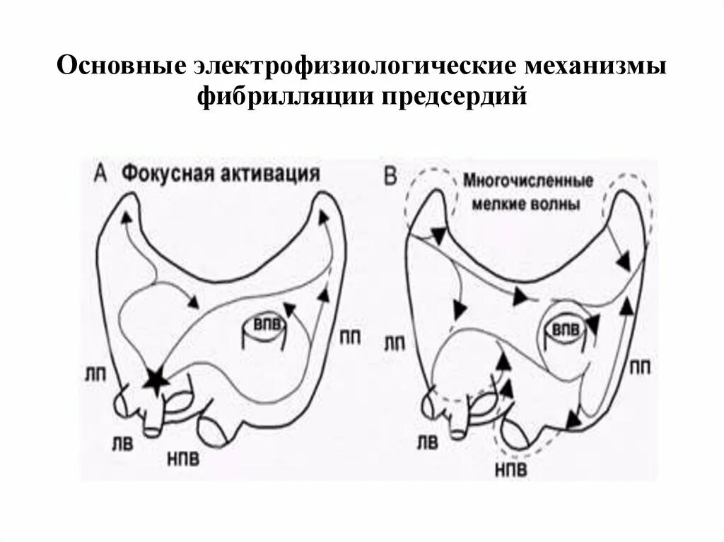 Хсн и фибрилляция предсердий. Механизм фибрилляции предсердий. Механизм формирования фибрилляции предсердий. Фибрилляция предсердий механизм развития. Фибрилляция предсердий механизм развития.