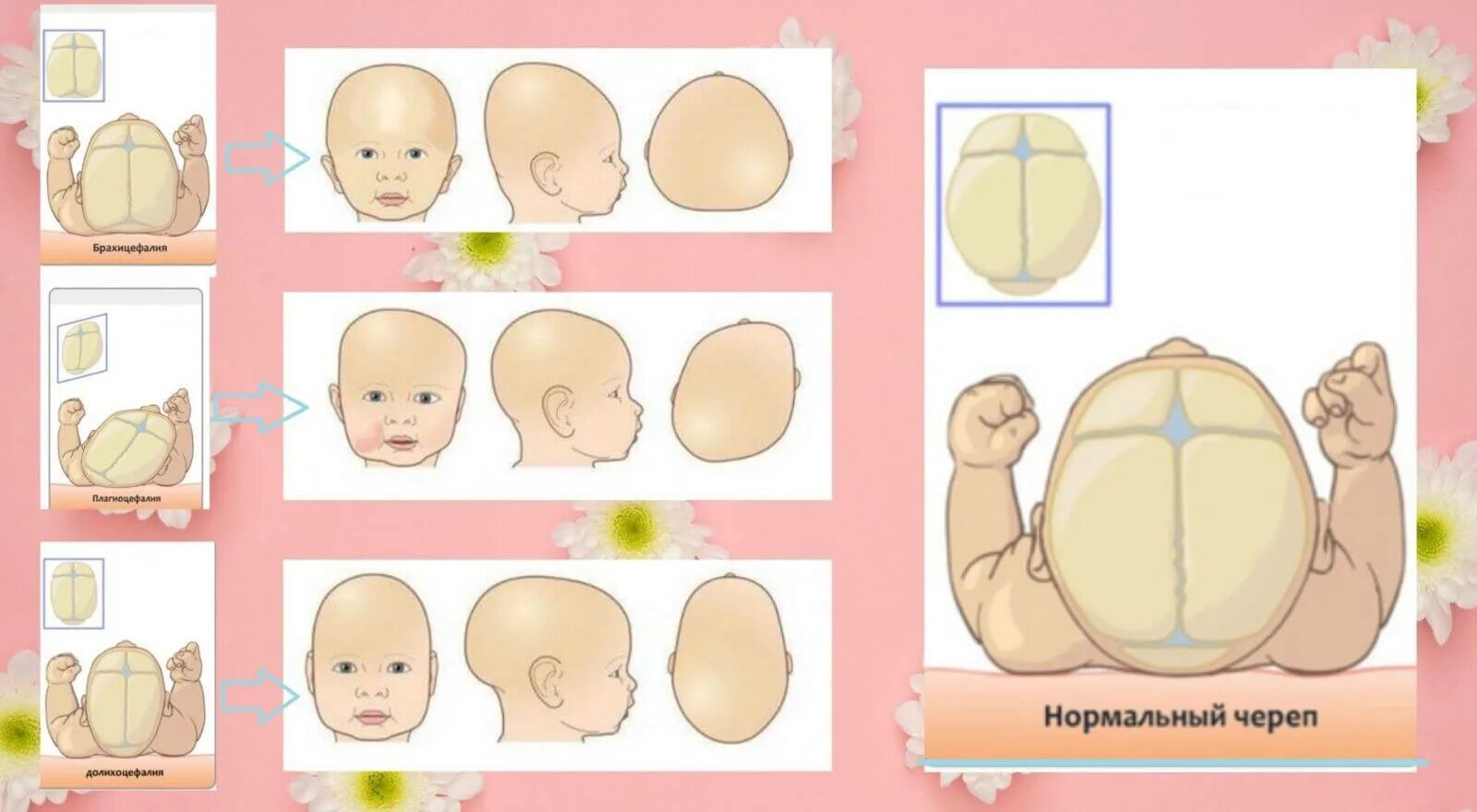 Мозг новорожденного норма. Форма черепа у грудничка норма. Форма головы у 2 месячного ребенка норма. Форма головы у грудничка 5 месяцев норма. Форма черепа у новорожденного норма в 1 месяц.