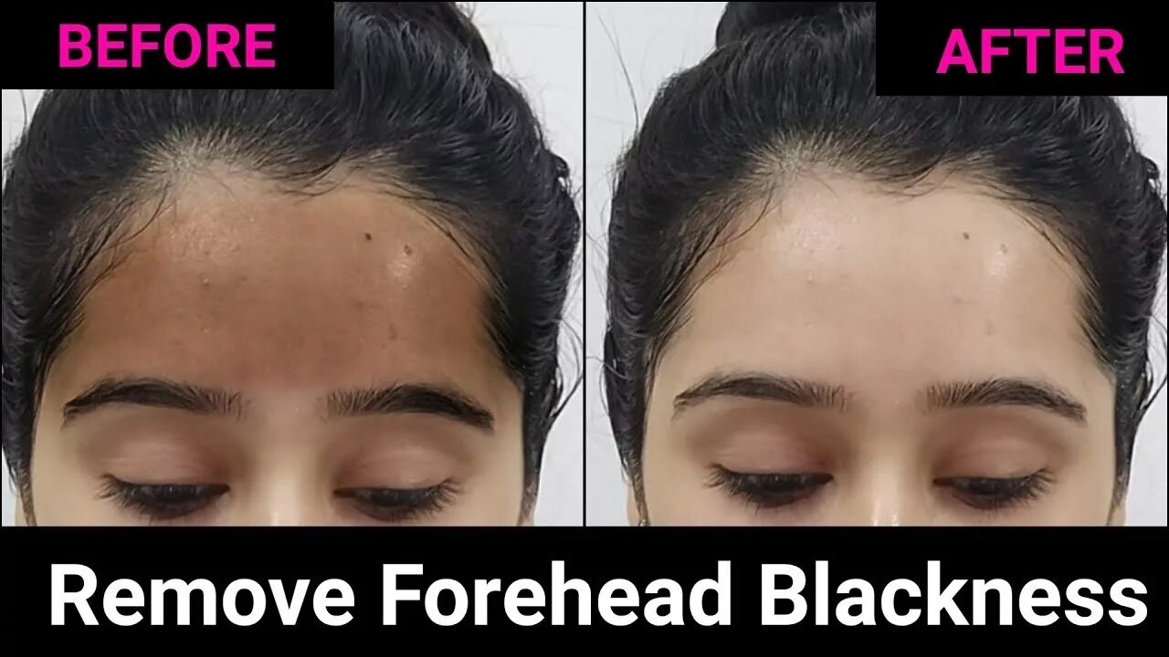 Песня черный лоб. Черный лоб. Two Hawaiian people forehead to forehead. A Special Cream for removing Blackheads on the face.